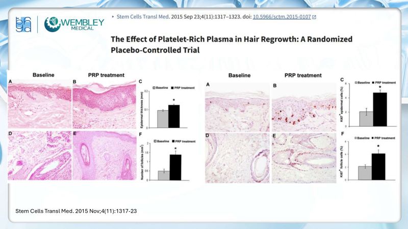 Bài báo cáo: Nguồn sống tự thân cho các vấn đề của da đầu: Tiềm năng sinh học của huyết tương giàu tiểu cầu