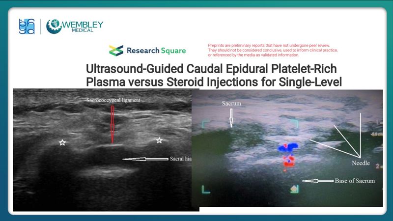 Bài báo cáo: Hiệu quả của huyết tương giàu tiểu cầu trong điều trị đau mạn tính