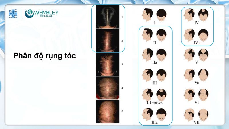 Bài báo cáo: Nguồn sống tự thân cho các vấn đề của da đầu: Tiềm năng sinh học của huyết tương giàu tiểu cầu