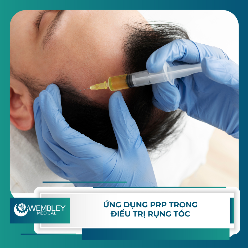 Ứng dụng PRP trong điều trị rụng tóc: Giải pháp hiệu quả, tự nhiên từ máu tự thân