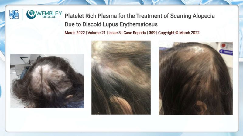 Bài báo cáo: Nguồn sống tự thân cho các vấn đề của da đầu: Tiềm năng sinh học của huyết tương giàu tiểu cầu