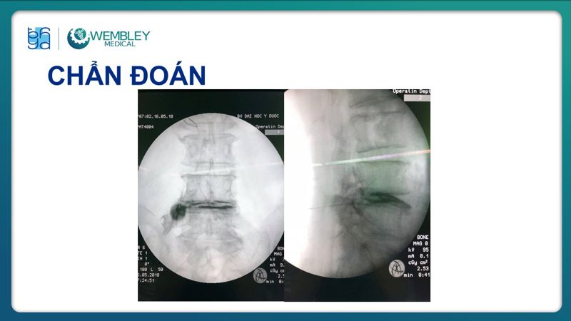 Bài báo cáo: Hiệu quả của huyết tương giàu tiểu cầu trong điều trị đau mạn tính