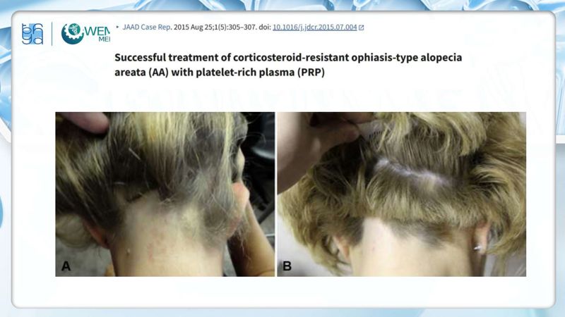 Bài báo cáo: Nguồn sống tự thân cho các vấn đề của da đầu: Tiềm năng sinh học của huyết tương giàu tiểu cầu