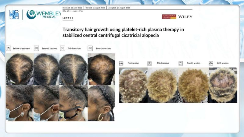 Bài báo cáo: Nguồn sống tự thân cho các vấn đề của da đầu: Tiềm năng sinh học của huyết tương giàu tiểu cầu