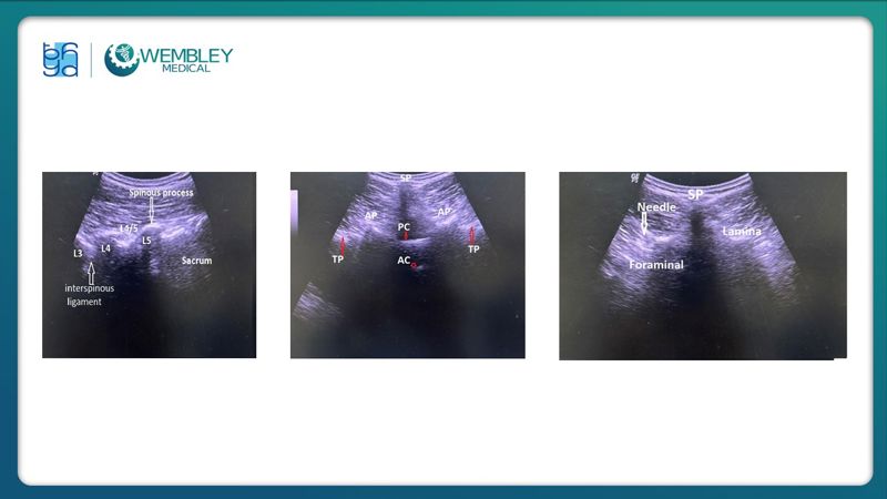 Bài báo cáo: Hiệu quả của huyết tương giàu tiểu cầu trong điều trị đau mạn tính