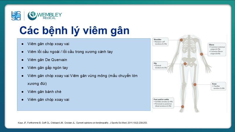 Bài báo cáo: Ứng dụng PRP trong điều trị bệnh lý viêm gân 