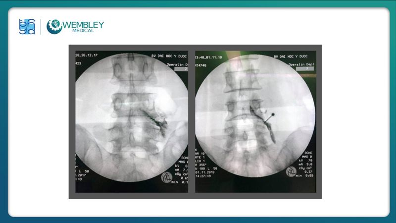 Bài báo cáo: Hiệu quả của huyết tương giàu tiểu cầu trong điều trị đau mạn tính